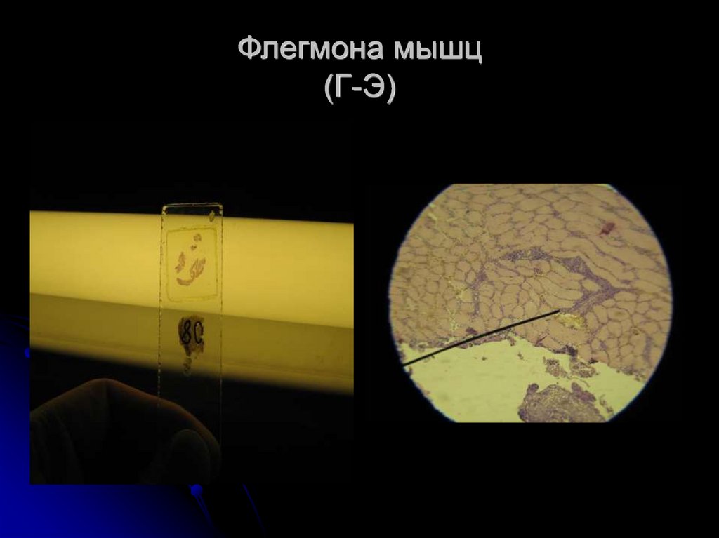 Флегмона мышц (Г-Э)