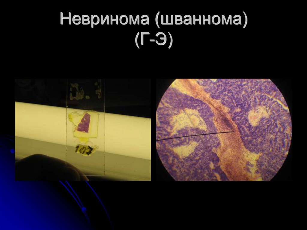 Невринома (шваннома) (Г-Э)