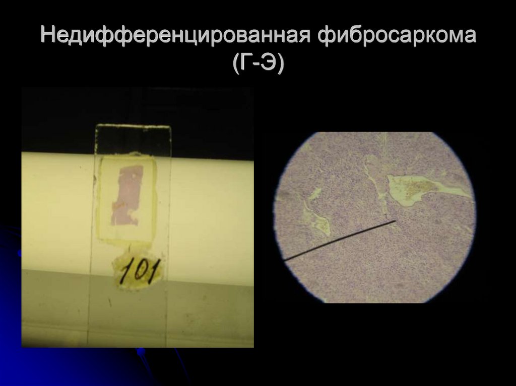 Недифференцированная фибросаркома (Г-Э)