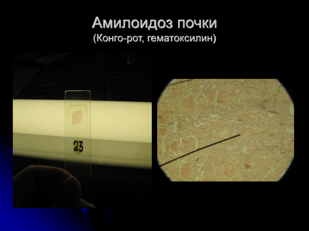 Амилоидоз почки (Конго-рот, гематоксилин)