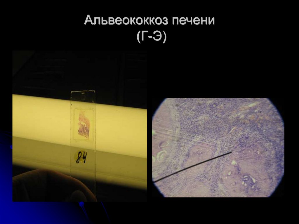 Альвеококкоз печени (Г-Э)