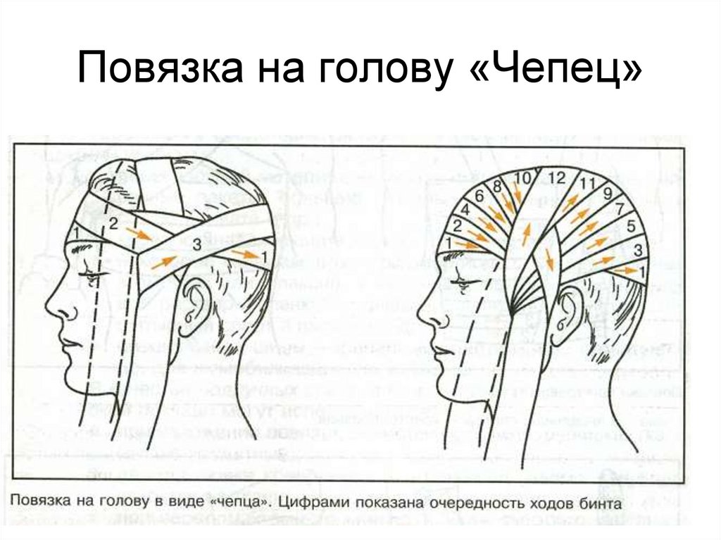 Перебинтовать голову схема