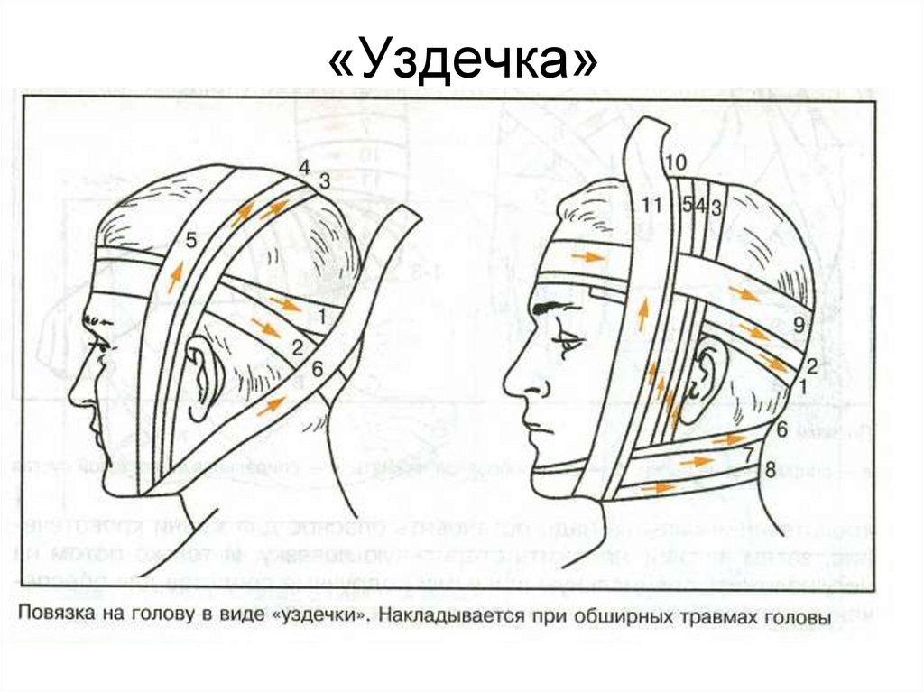 Схема бинтования головы