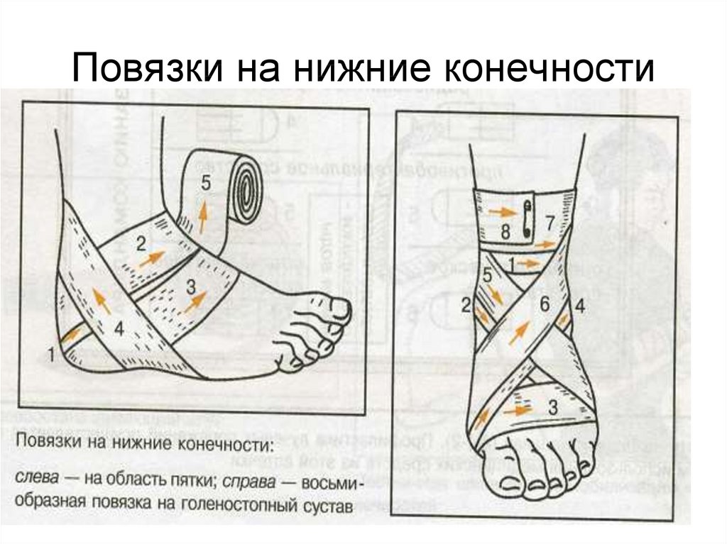 Какая повязка накладывается при повреждении голеностопного сустава. Десмургия повязки на конечности нние. Алгоритм наложения повязки на нижние конечности. Аоаязуи на нижние конечности. Бинтовые повязки на нижнюю конечность.