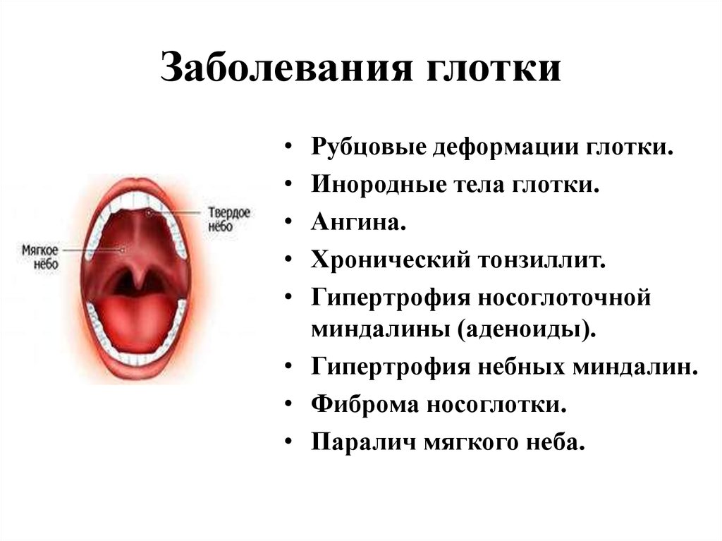 Сыпь температура боль в горле у ребенка. Хронический фарингит факторы. Хронический тонзиллит факторы. Небные миндалины тонзиллит.