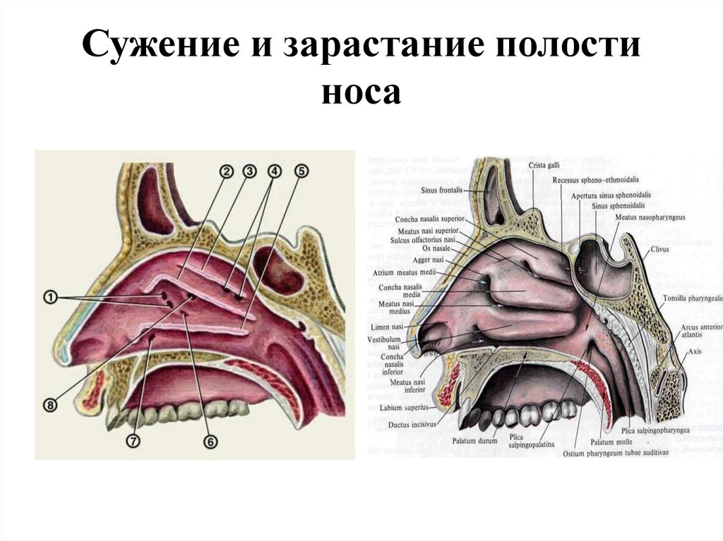 Слизистые оболочки носовых ходов. Пазухи носовой полости анатомия. Строение носовой перегородки внутри. Анатомия искривлённой носовой перегородки. Строение носовой перегородки раковина.