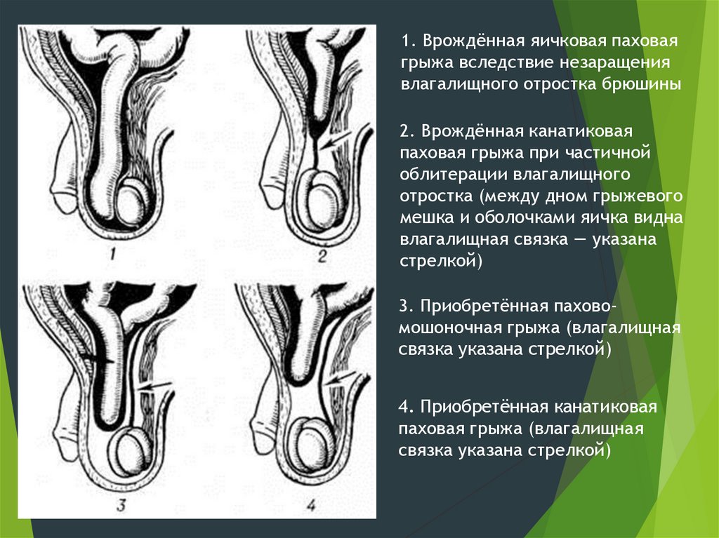 Аномалия развития влагалищного отростка брюшины - презентация онлайн