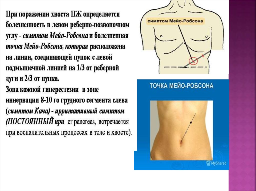 Точки признак. Симптом Мейо-Робсона при панкреатите. Острый панкреатит симптом Мейо–Робсона. Симптом кача Мейо Робсона.