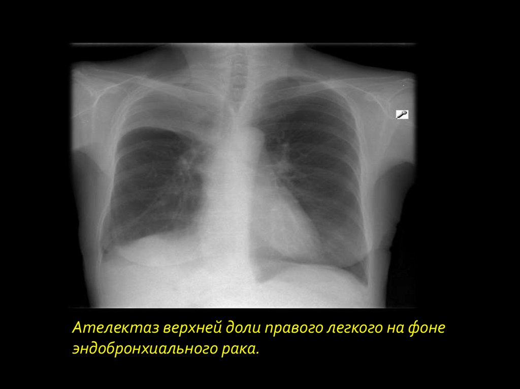 Рак легкого презентация онкология