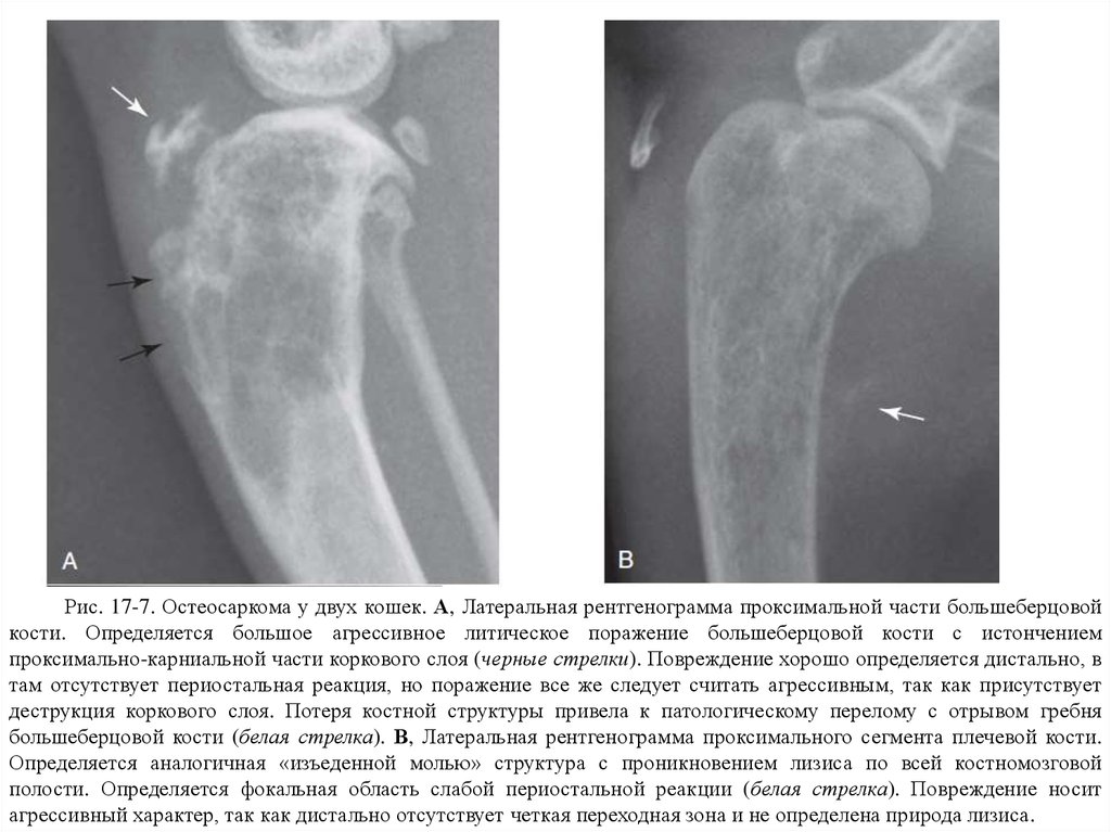 Симптомы рака костей у женщин. Остеосаркома бедренной кости кт. Остеосаркома плечевой кости кт. Остеосаркома рентгенограмма.