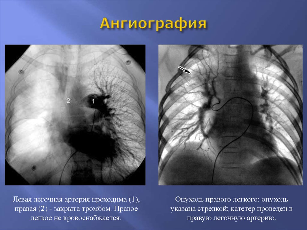 Опухоль правого. Ангиография легочной артерии. Ангиография легочных сосудов. Ангиография при легочном кровотечении.