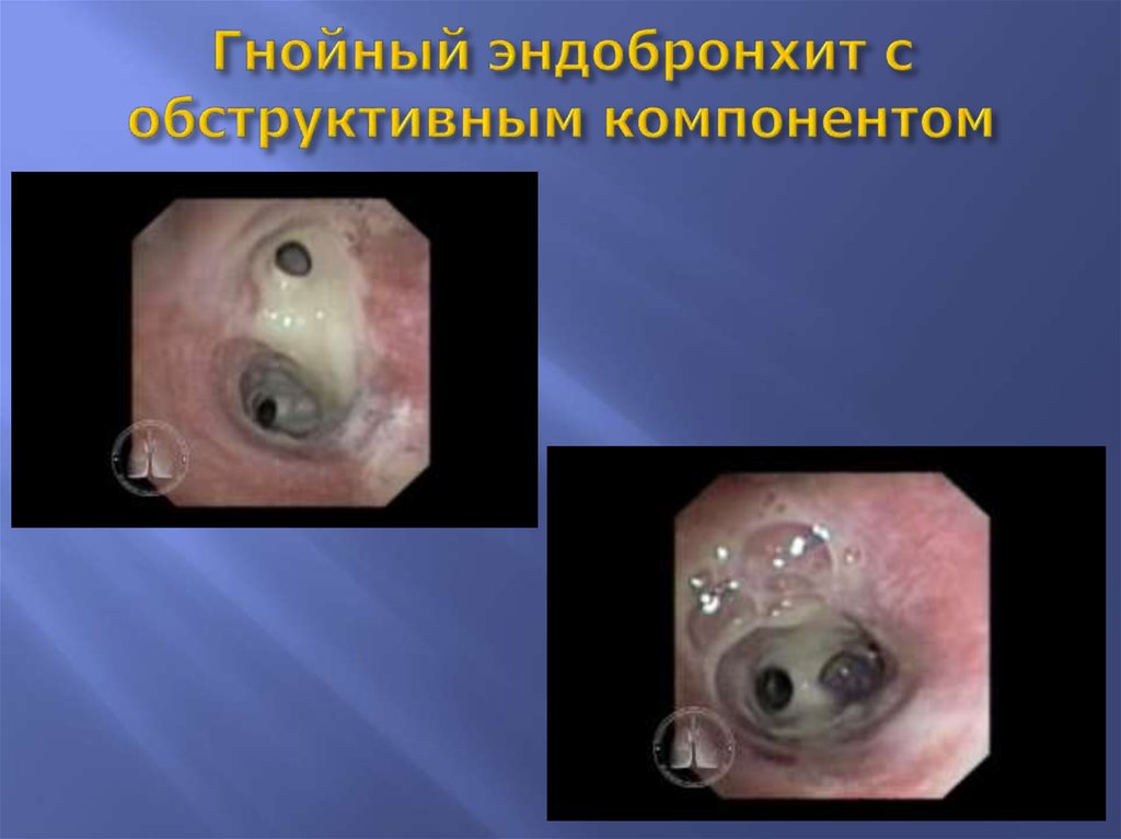 Гнойный эндобронхит с обструктивным компонентом