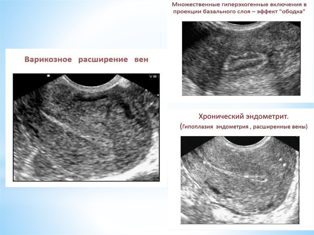 Структурные изменения матки