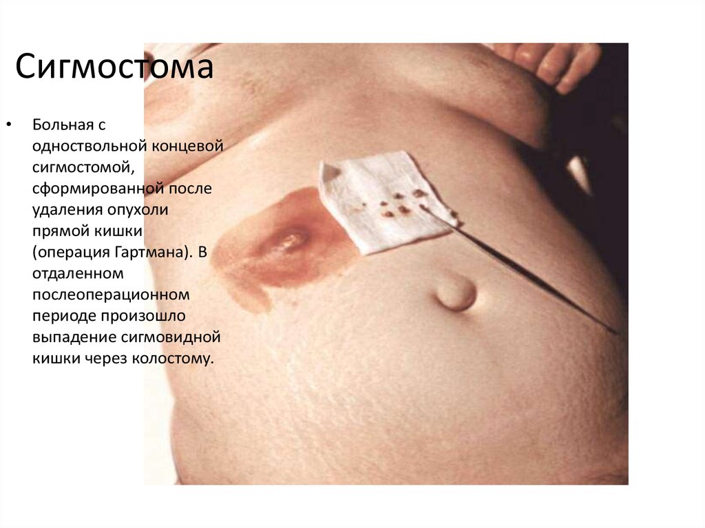 Сигмостома