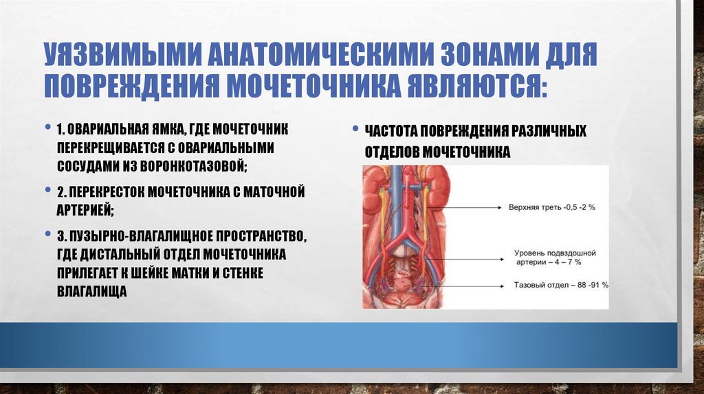 Травма мочеточника. Маточная артерия и мочеточник. Перекрест мочеточника с маточной артерией. Взаимоотношения маточной артерии и мочеточника. Маточная артерия и мочеточник взаимоотношение.