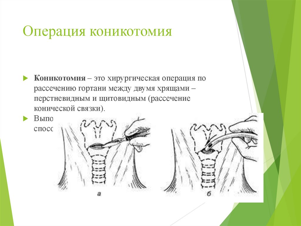 Операция трахеотомия