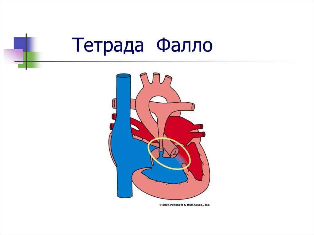 Тетрада фалло клиническая картина