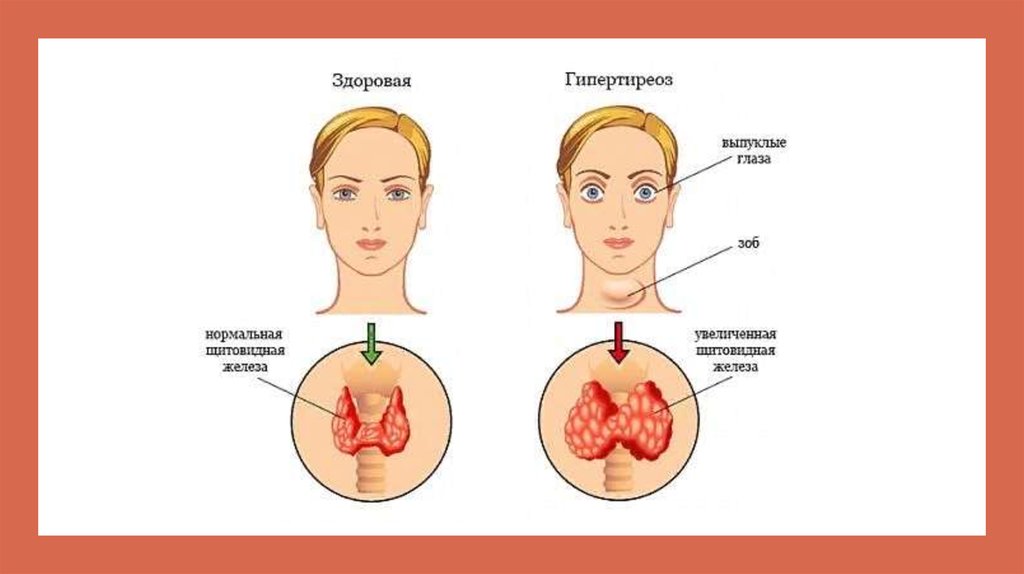 Eutirox hipertiroidismo