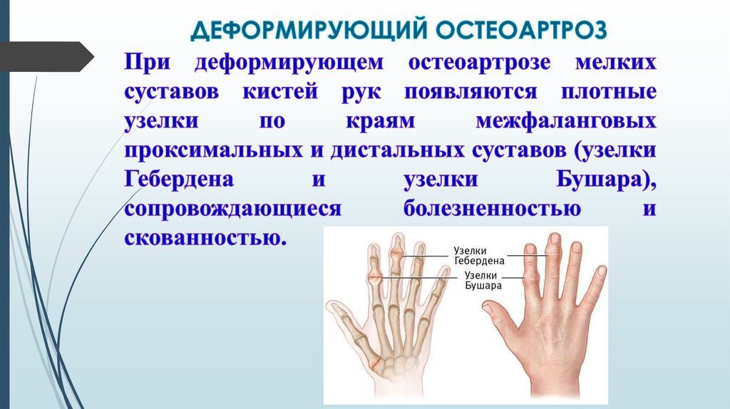 Деформирующий артроз презентация