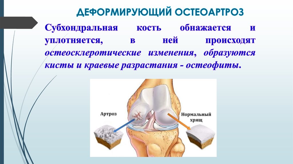 Лечение деформирующего остеоартроза презентация