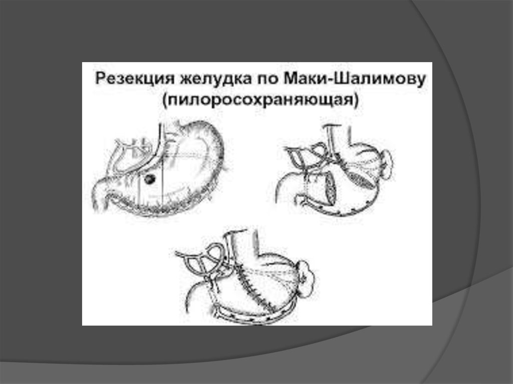 Рак желудка операция. Пилоросохраняющая резекция желудка рентген. Резекция по маки Шалимову. Резекция желудка по Шалимову. Резекция желудка по маки Шалимову.