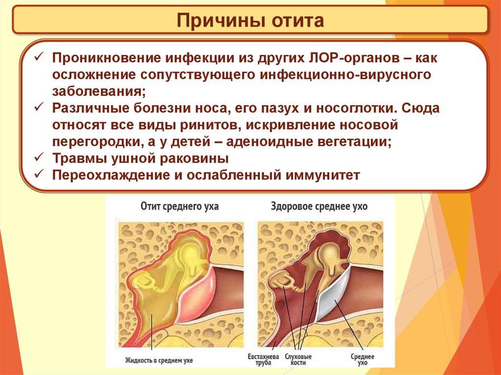 Воспаление внутреннего уха лечение. Острый Гнойный средний отит профилактика. Гнойный отит наружного уха. Наружный средний Гнойный отит. Клинические симптомы отита.