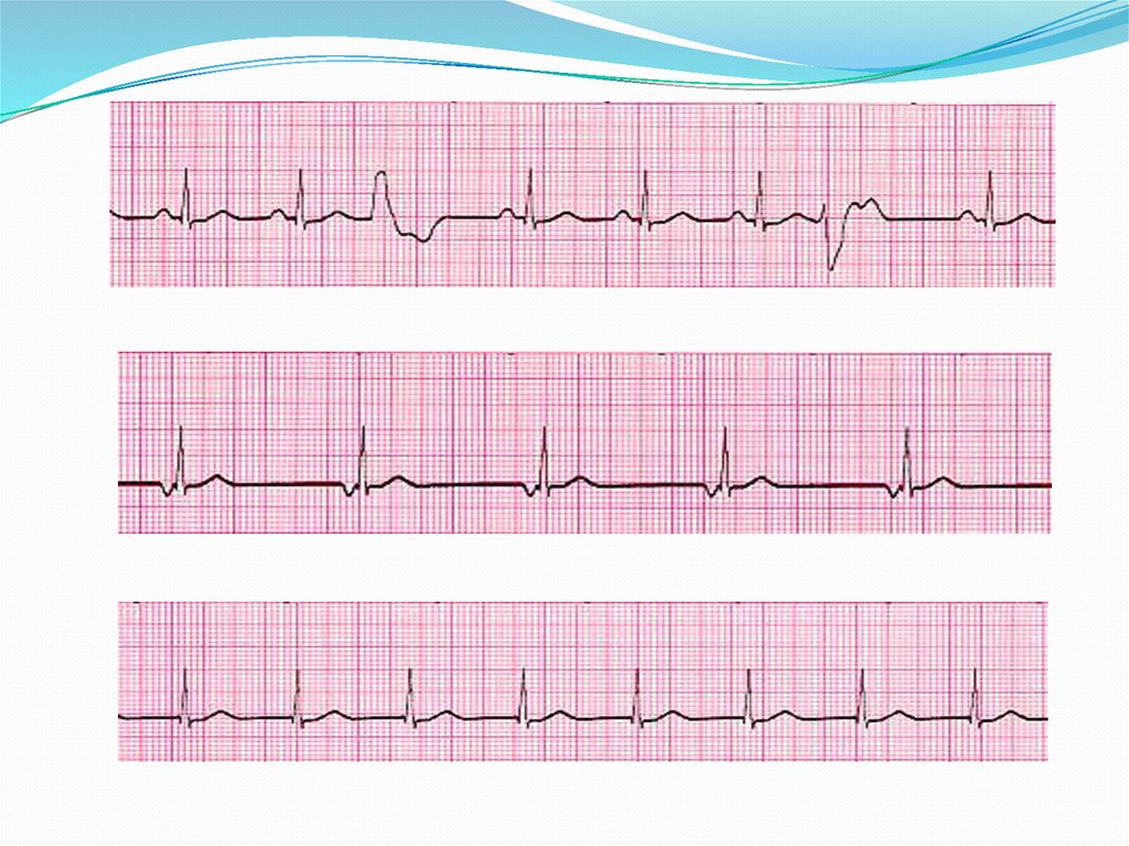 Экг нарушение проводимости. ЭКГ диагностика нарушений ритма и проводимости. Нарушения ритма на ЭКГ. Нарушения в кардиограмме. Скорость записи ЭКГ при нарушении ритма.