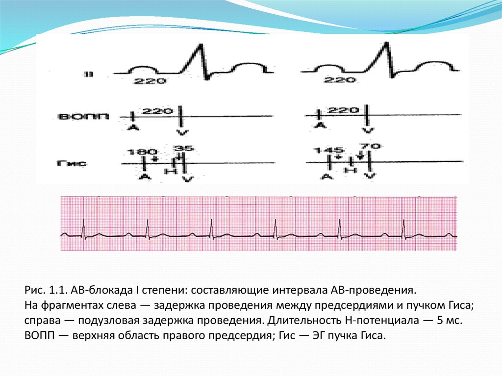 Ав блокада сердца 1 степени. Блокады проводимости сердца ЭКГ. Атриовентрикулярная блокада на ЭКГ. Av блокада 1 степени. Атриовентрикулярная задержка на ЭКГ.