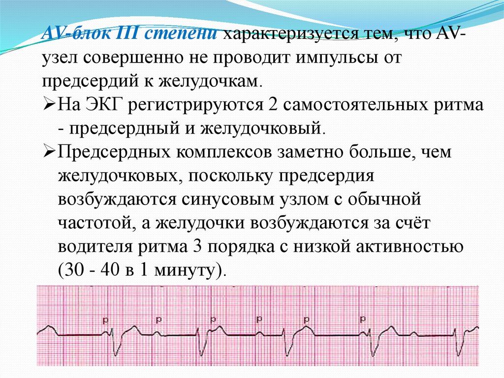 Экг нарушение проводимости. Нарушения ритма и проводимости: э. Изменение ЭКГ при нарушении ритма и проводимости. Виды нарушения ритма на ЭКГ. ЭКГ В патологии нарушение ритма и проводимости.