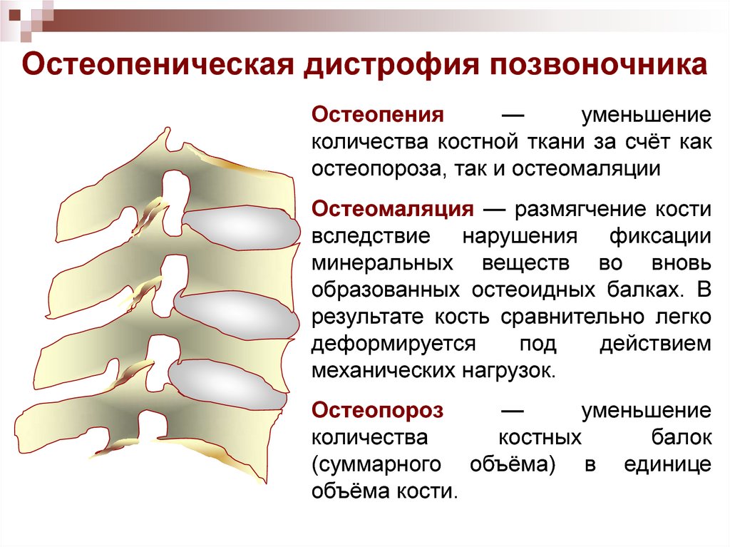 Дистрофические изменения костей. Остеопения l1 l2 позвонков. Дистрофически-дегенеративные изменения позвоночника. Остеопения позвоночника l1-l4. Дегенерация диска поясничного отдела позвоночника.