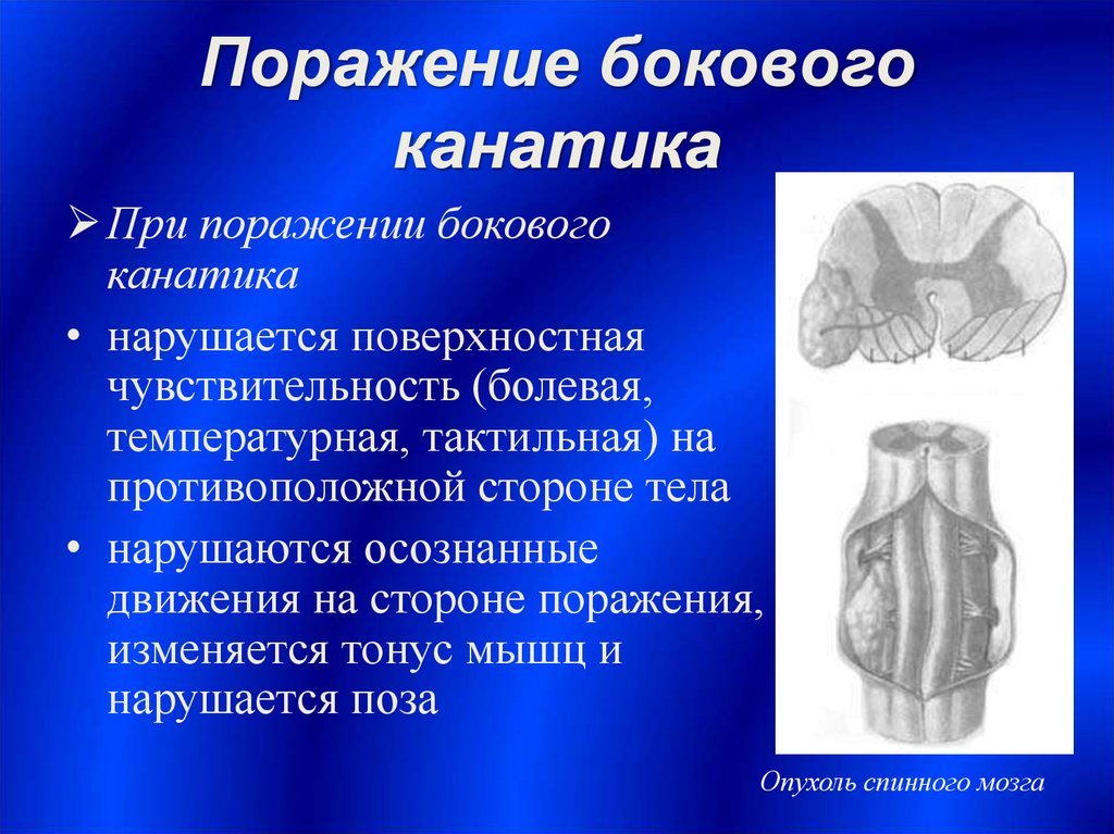 Канатики мозга. При поражении задних канатиков спинного мозга развивается. Поражение боковых канатиков спинного мозга. Синдром поражения боковых канатиков. При поражении бокового канатика.