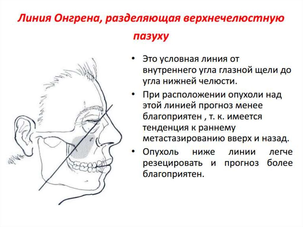 Злокачественная опухоль пазухи носа. Пункция гайморовой пазухи этапы. Лечение злокачественных новообразований верхнечелюстной пазухи.. Опухоль верхнечелюстных пазух носа. Злокачественное новообразование верхнечелюстной пазухи.