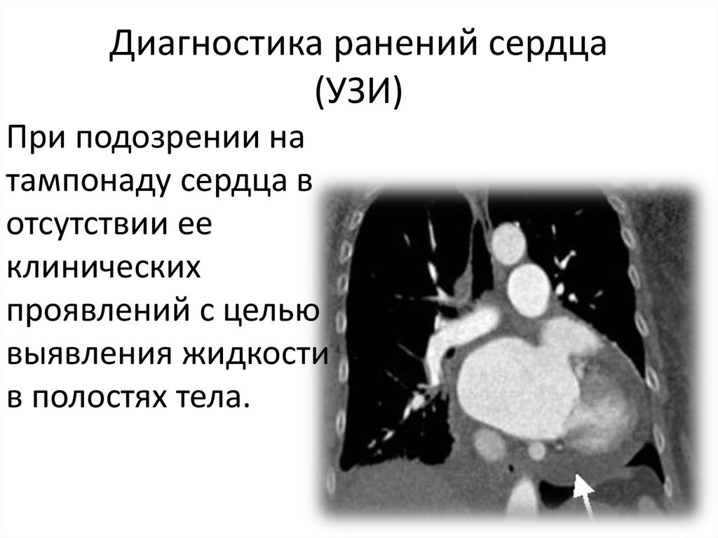 Закрытая травма сердца презентация