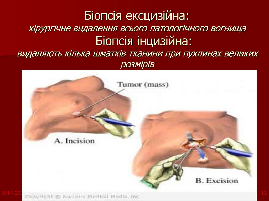 Біопсія ексцизійна: хірургічне видалення всього патологічного вогнища Біопсія інцизійна: видаляють кілька шматків тканини при