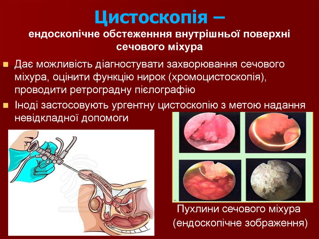 Цистоскопія – ендоскопічне обстеженння внутрішньої поверхні сечового міхура