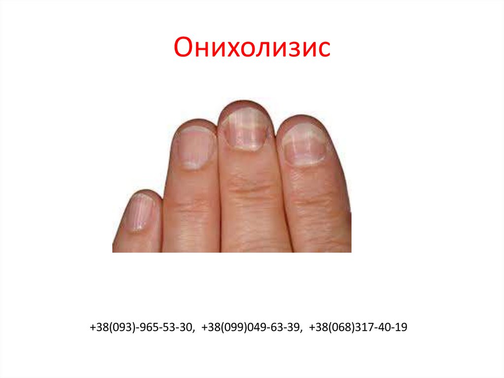 Определение болезни по ногтям на руках с фото и описанием для женщин после 50 лет