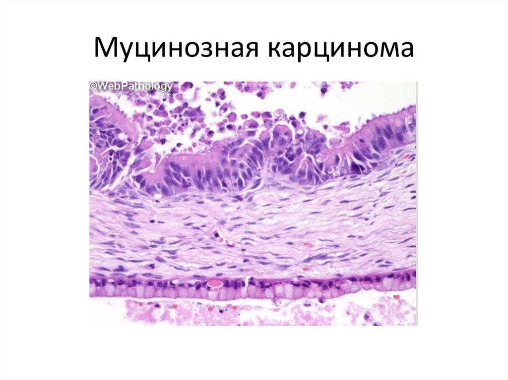 Муцинозный рак. Серозная цистаденокарцинома гистология. Серозная карцинома яичника гистология. Серозная опухоль гистология.