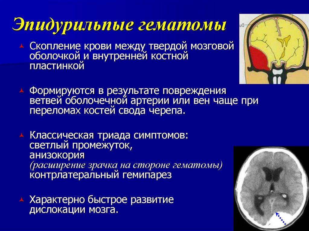 Гематома черепно мозговой травме. Эпидуральная гематома светлый промежуток. Внутричерепная гематома симптомы. Для эпидуральной гематомы характерны.