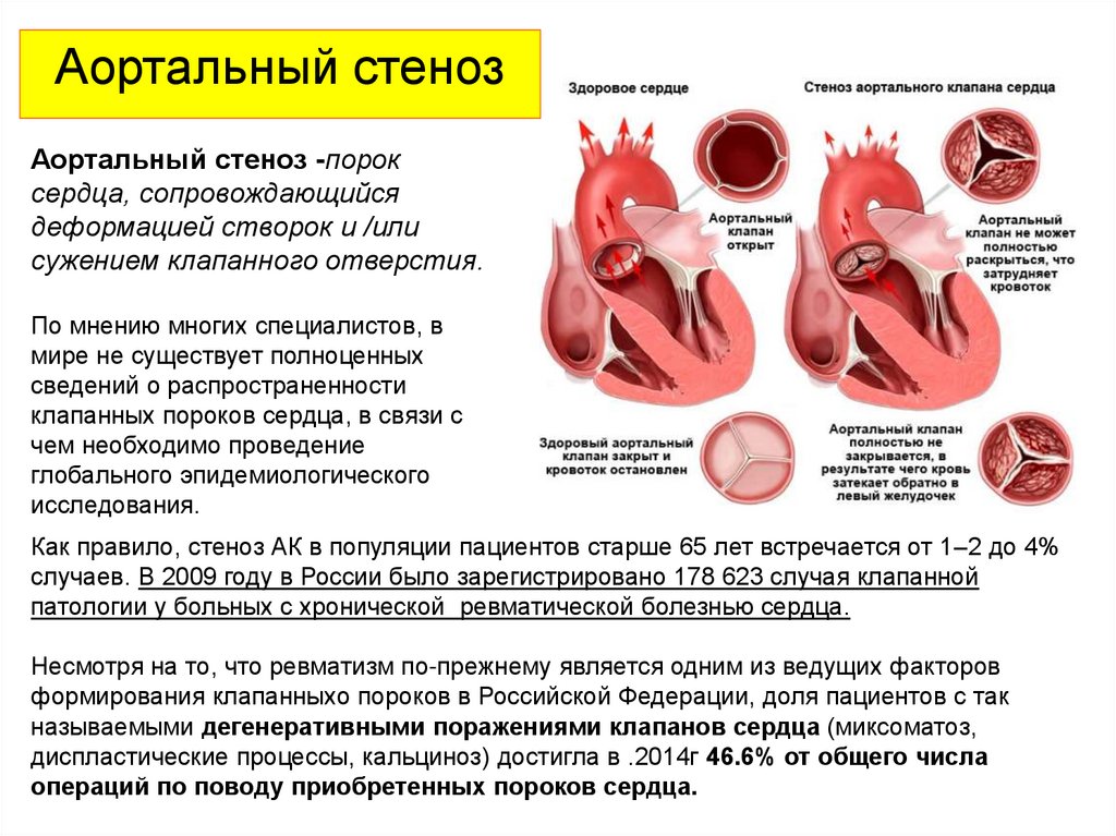 Аортальный стеноз что это такое. Порок сердца стеноз аортального клапана. Пороки сердца аортальный стеноз и недостаточность. Аортальный клапан 3 створчатый. Аортальный стеноз патанатомия.