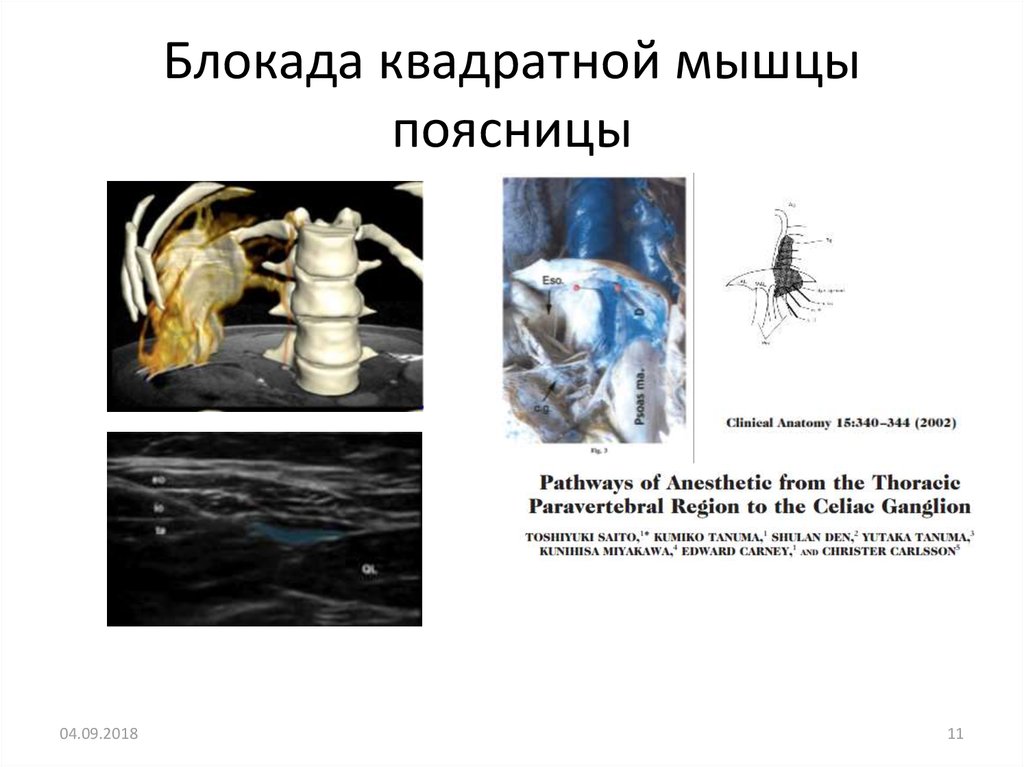 Блокада квадратной мышцы поясницы