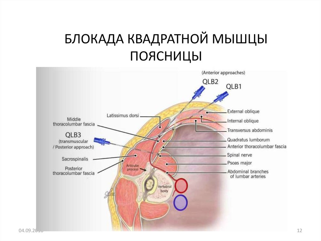 БЛОКАДА КВАДРАТНОЙ МЫШЦЫ ПОЯСНИЦЫ