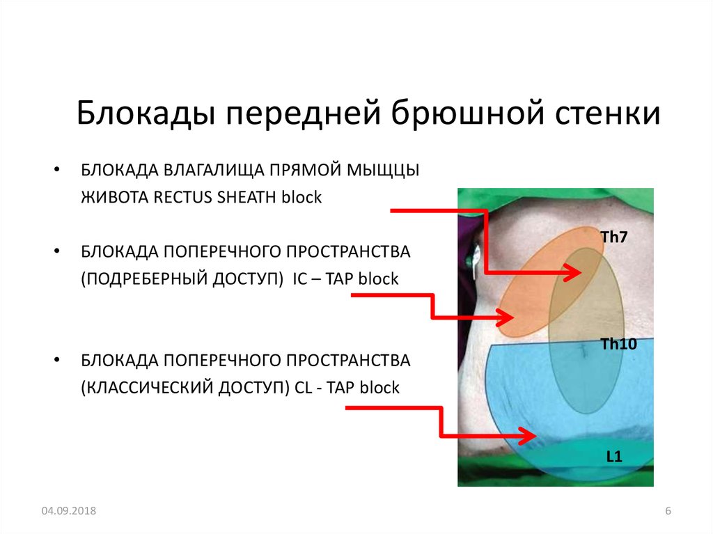 Блокады передней брюшной стенки