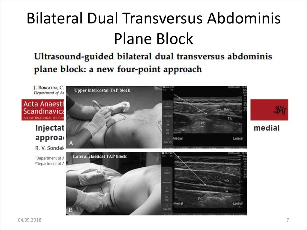Bilateral Dual Transversus Abdominis Plane Block