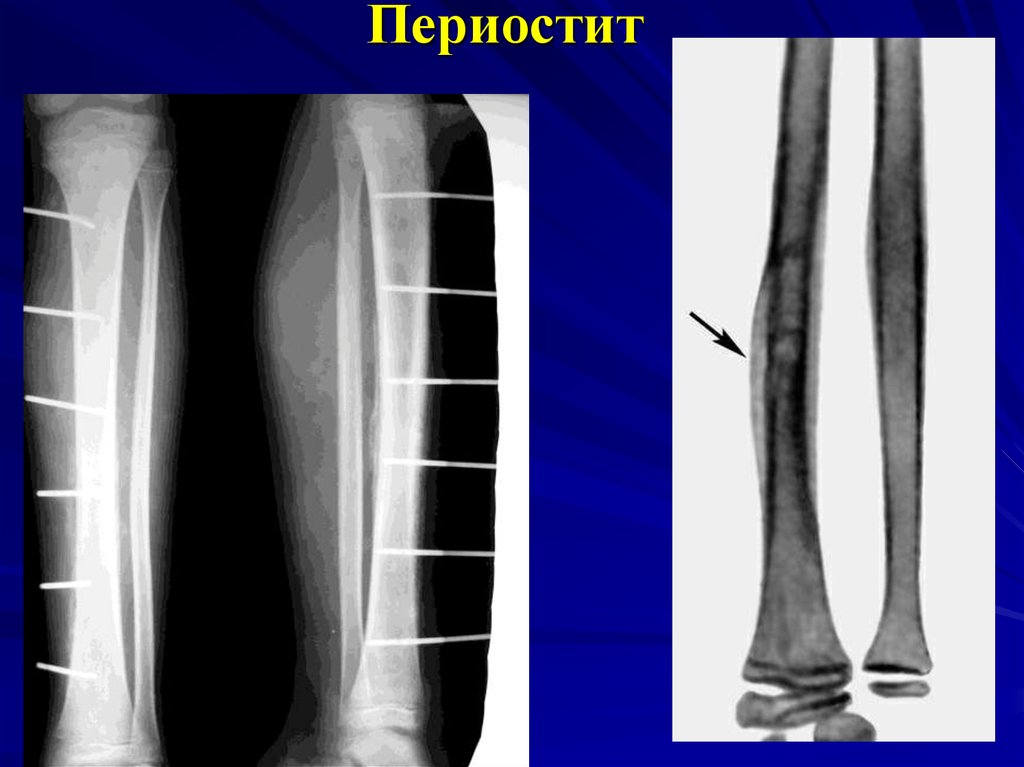 Периостит голени. Оссифицирующий периостит. Периостит кости голени. Периостит большеберцовой рентген. Периостит надкостницы большеберцовой кости.