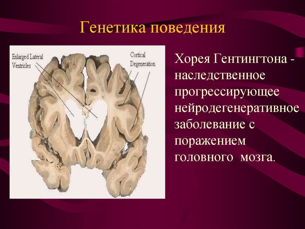 Болезнь гентингтона презентация