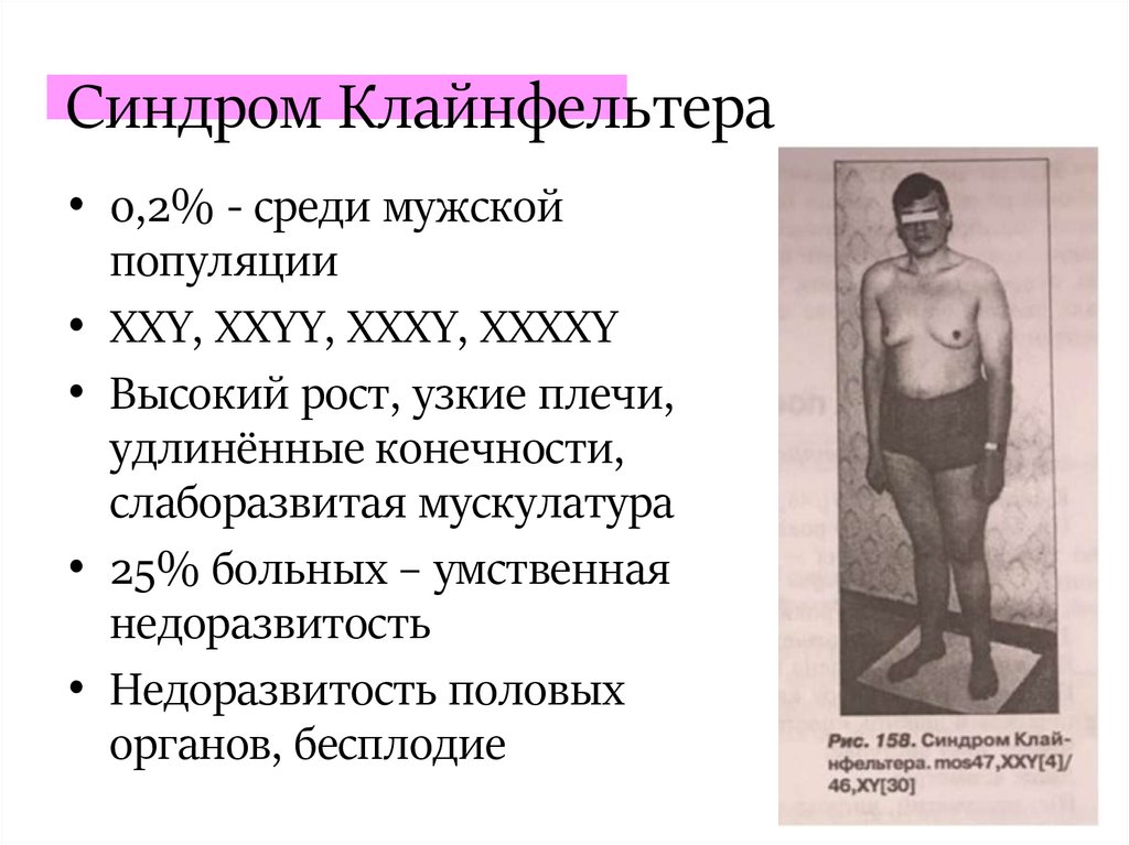 Синдром Клайнфельтера