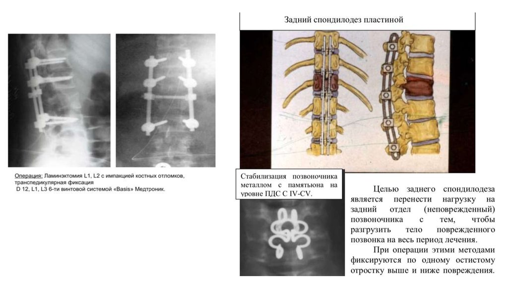 Компрессионный перелом карта вызова