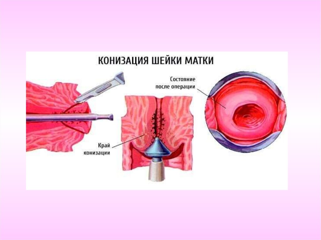 Конизация шейки матки. Э/конизация шейки матки.