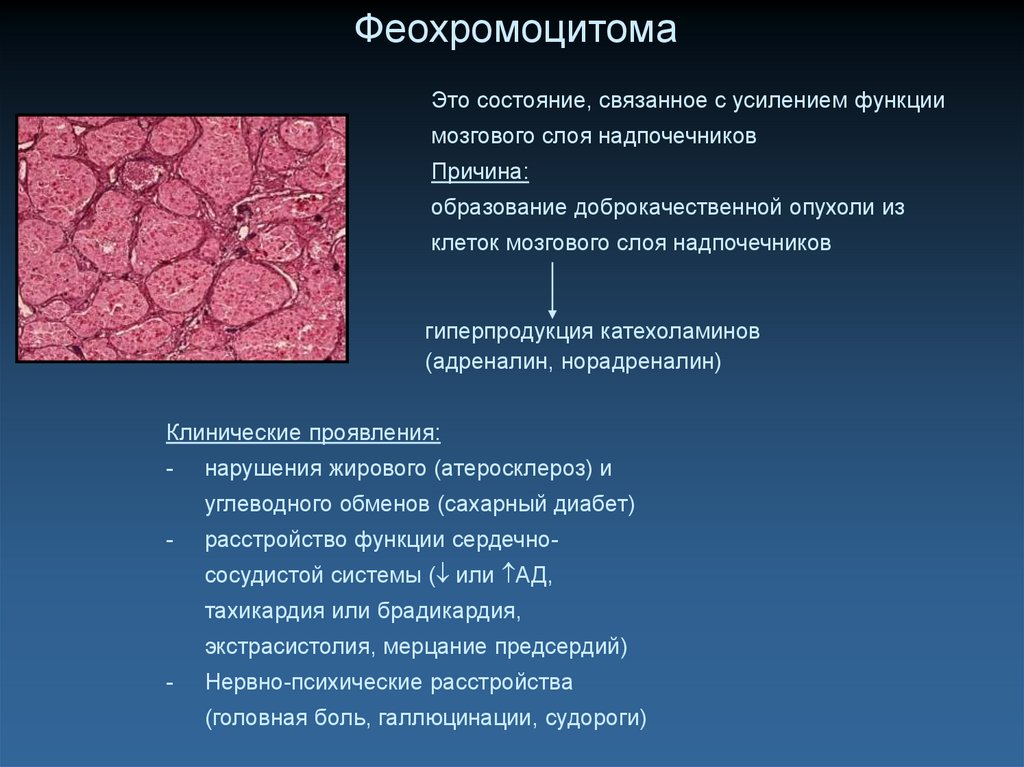 Гормонально активные опухоли надпочечников