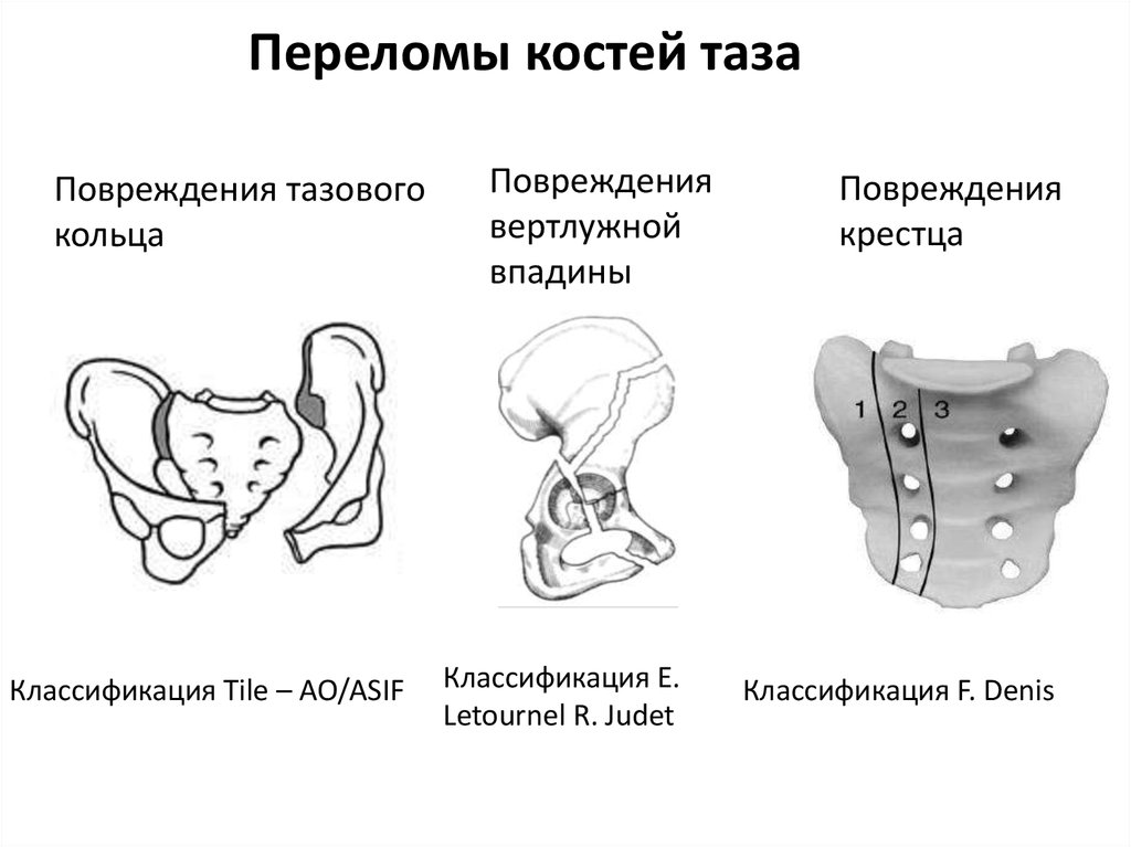 Закрытый перелом костей таза карта вызова